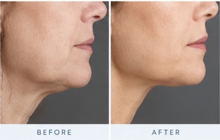 Morpheus8 lower face and jawline results