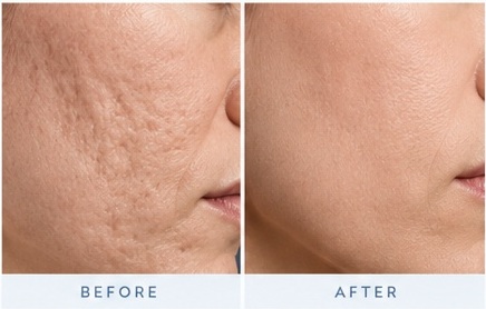 Morpheus8 acne scars and texture results